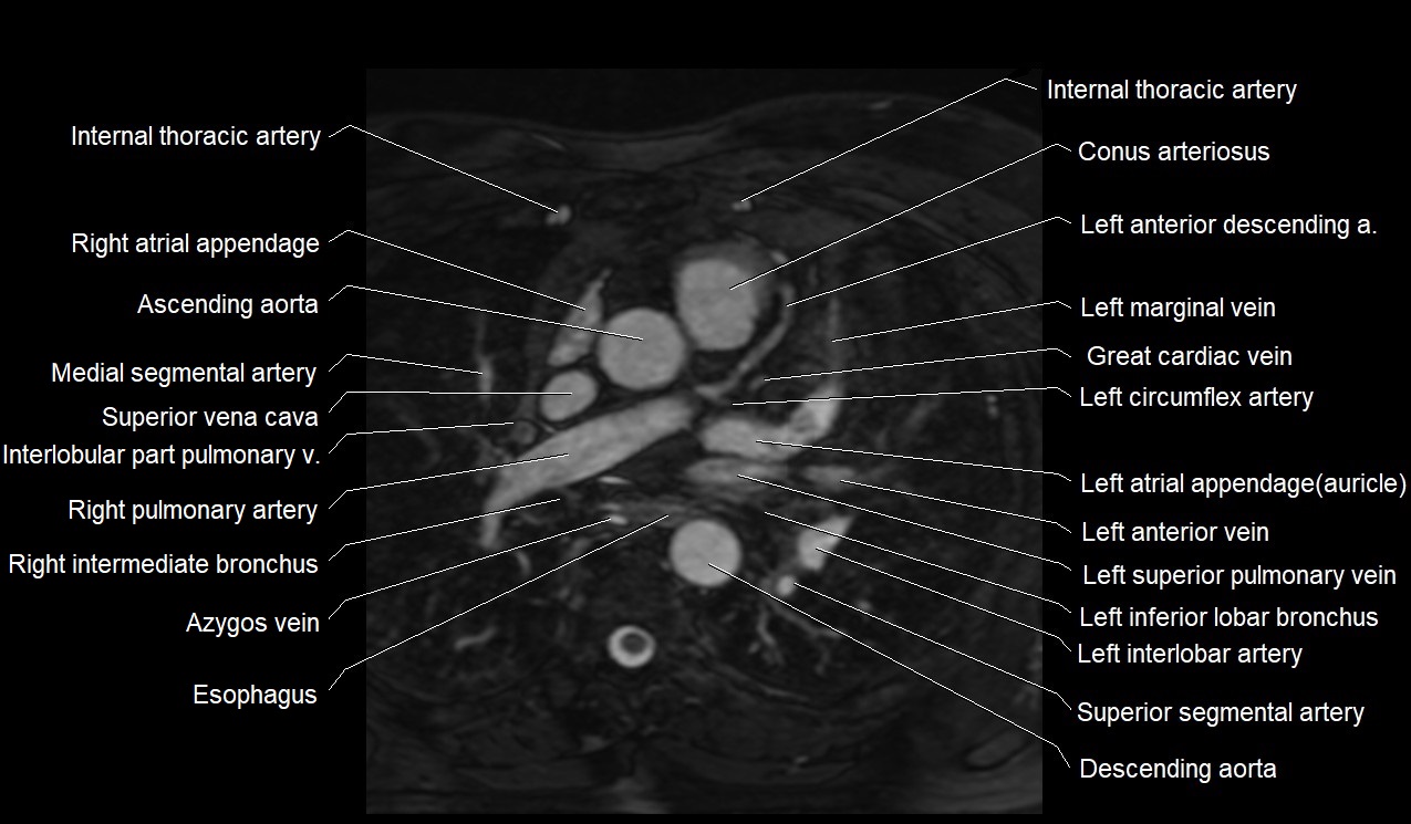 MRI heart coronary arteries and coronary veins anatomy axial image 11.jpg